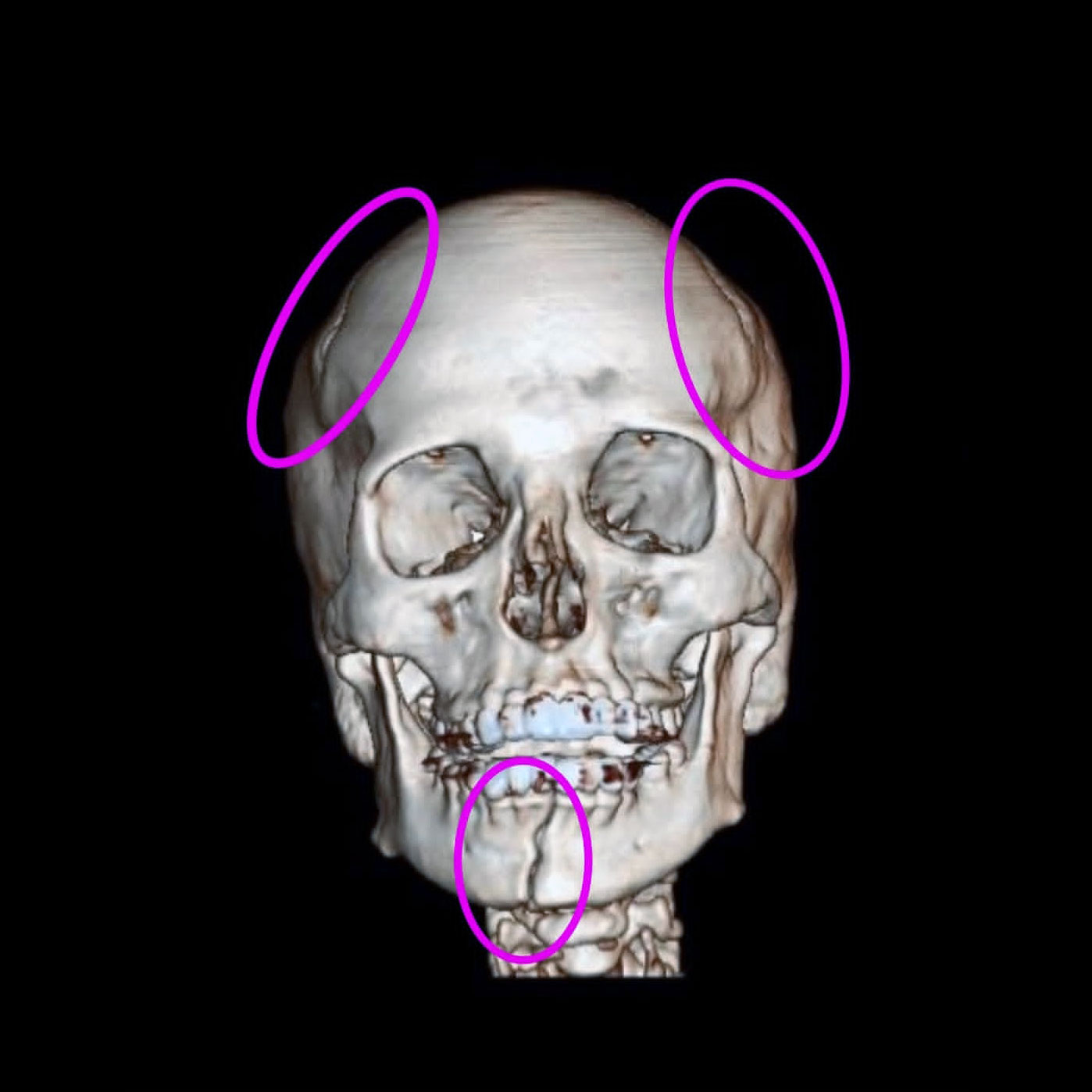 شکستگی سر و جمجمه از سه ناحیه دختر 31 ساله به دلیل تصادف موتور سواری