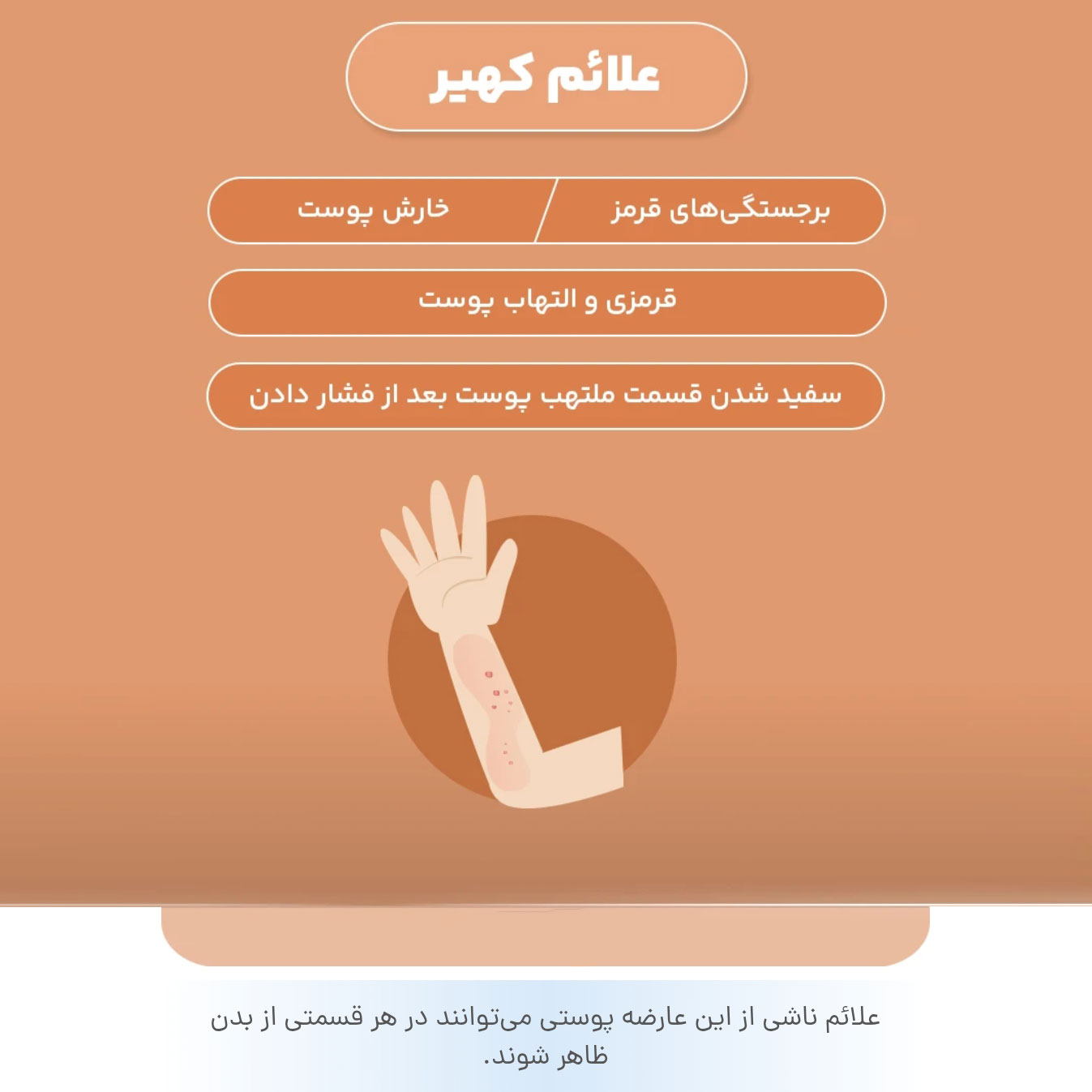 علائم کهیر + چهار مورد اصلی