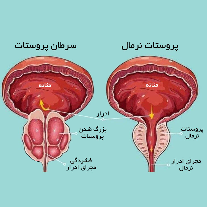 عکس تفاوت سرطان پروستات با پروستات سالم نرمال