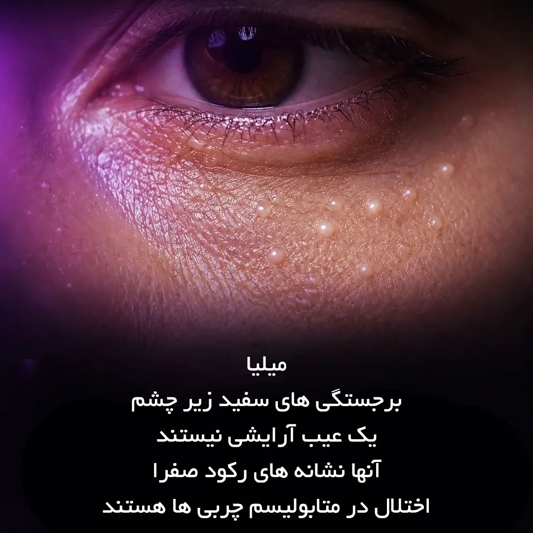 میلیا یا برجستگی های سفید زیر چشم چیست ؟ آیا ارتباطی با صفرا دارد ؟