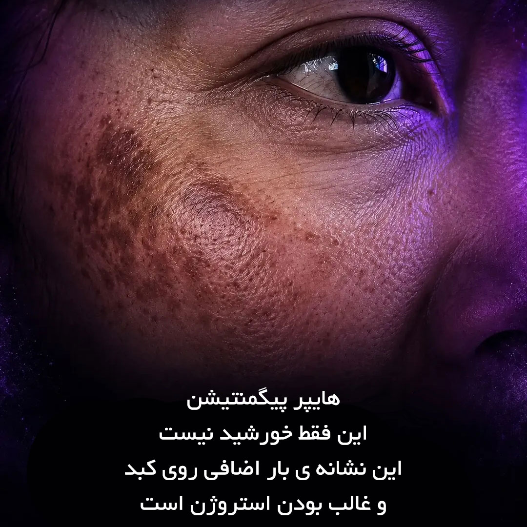 هایپر پیگمنتیشن چیست ؟ آبا با کبد ارتباطی دارد ؟